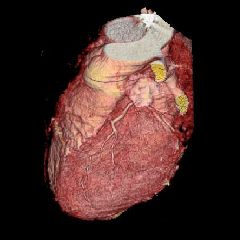 3d reconstruction of the heart
