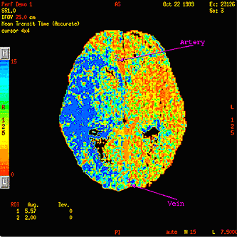 Figure 6: Typical CT perfusion image of the brain (courtesy GE Medical Systems)