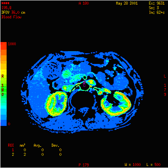 Figure 6: Typical CT perfusion image of the kidneys (courtesy GE Medical Systems)