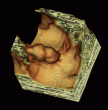 Figure 5: Endolumenal view of colon, showing large polyp (courtesy Voxar Ltd)