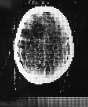 Image from the EMI CT Scanner