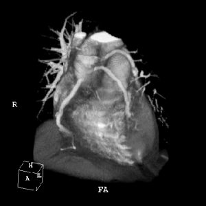 Volume rendered CT angiography of coronary arteries (Marconi Mx8000)