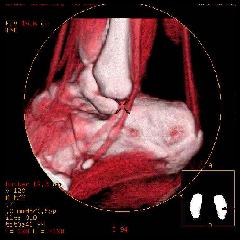 Calcaneal Spur