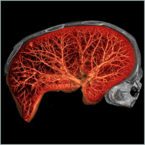 Figure 2: Volume rendered lung image showing nodule near chest wall. Image courtesy of TeraRecon, Inc