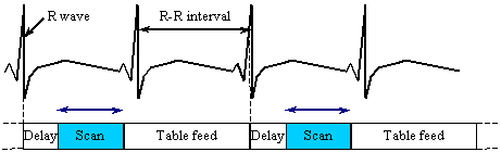 Figure 1 ECG signal, R-R interval and Prospective